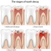 Stages Of Tooth Decay