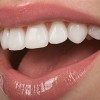 Beautiful Porcelain Veneers