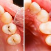 Before And After composite Fillings