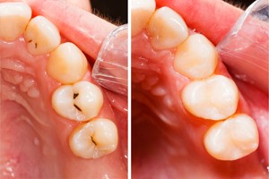 Before And After composite Fillings