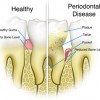 Healthy Teeth Vs Perio Disease