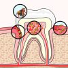 Tooth Section With Damage And Germs