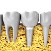 Dental Implant Side View