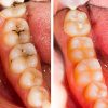 Before and After Dental Treatment