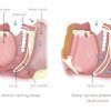 Obstructive Sleep Apnea