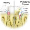 Healthy Teeth VS Periodontal Disease