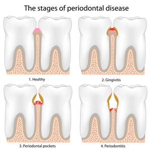 Stages of Periodontal Disease