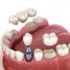 Dental Implant VS Crown and Bridge