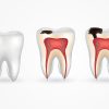 Stages of Cavities