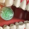 Bacteria & Microbes around Tooth