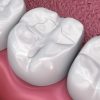 Tooth-Colored Fillings