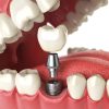 Dental Implant Illustration