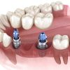 Restoration with Dental Implants