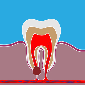 Dental Abscess