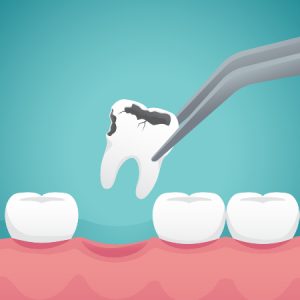 Tooth Extraction and Dry Socket