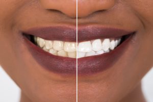 Before and After Teeth Whitening