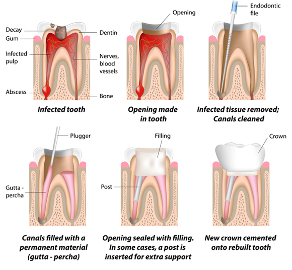 Root Canal Process Root Canal Process
